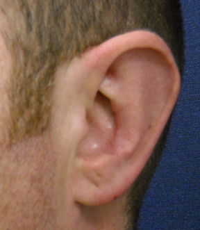 Chicago Otoplasty Surgery